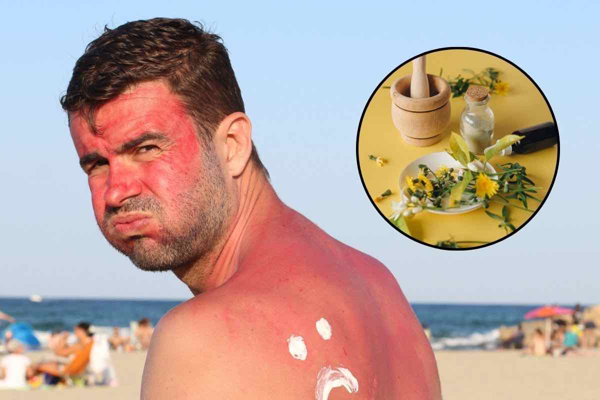 Uomo con pelle scottata e rimedi naturali
